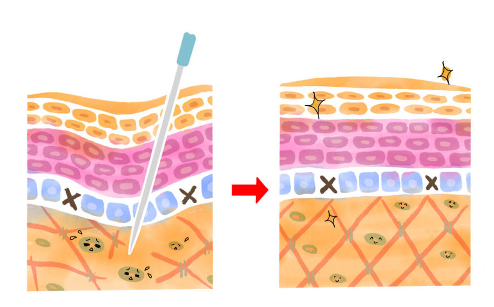 鍼を刺した皮膚の断面イラスト